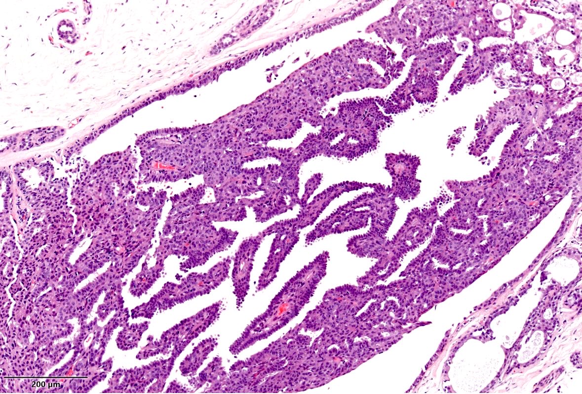 vintage81106614's tweet image. Diagnosis at first glance. A 46 yo woman with right nipple clear discharge. Final Dx. Intraductal papilloma in core biopsy. #pathology #pathres #pathtwitter #breast #tumors