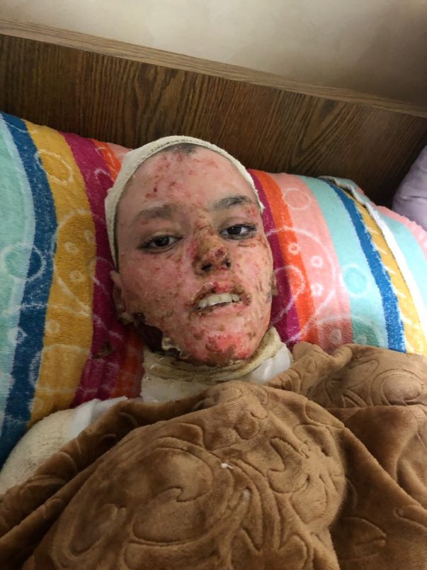 rifain_nouvelle's tweet photo. 🔴Sarah, jeune fille palestinienne de 17 ans visage ravagé par le phosphore blanc de l’aviation israélienne à Gaza. https://t.co/T10eRDRtSI