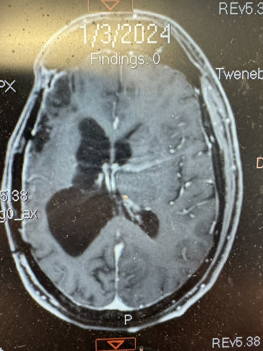 Results from this week. No new Timmor’s and post opBrain fluid levels labeling. # fightlikehell #nowhiteflags