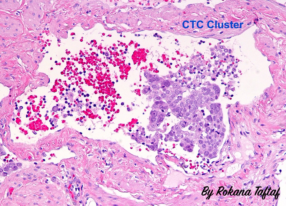 Rokana Taftaf, MD, PhD, MS (@rokanataftaf) on Twitter photo Whenever I discover a rare circulating tumor cell cluster in blood vessels of cancer patients during my residency, it brings back memories of the countless hours I spent searching for such clusters in my PhD study and I remember you Dr. Liu <a href="/LiuCluster/">Huiping Liu</a> ❤️
#Pathology #PathTwitter Whenever I discover a rare circulating tumor cell cluster in blood vessels of cancer patients during my residency, it brings back memories of the countless hours I spent searching for such clusters in my PhD study and I remember you Dr. Liu <a href="/LiuCluster/">Huiping Liu</a> ❤️
#Pathology #PathTwitter