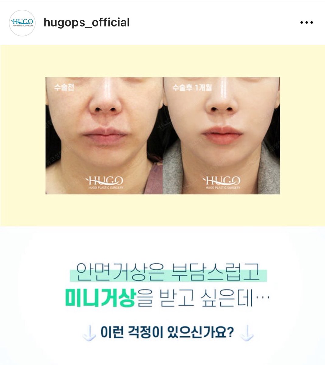 gyozanohitodesu's tweet photo. ほうれい線何とかしたいなら韓国のhugoがｵｽｽﾒ✍️切開リフトが有名で顔のリフト系がとにか上手。耳で切るから傷跡目立たない。私はほうれい線対策でメーラーファットの脂肪を少しだけ吸引と短い糸で上げてもらった。悩み皆無になって一気に若返った。メーラーは取りすぎると将来老けるので注意です。 https://t.co/xQTCewcnr6