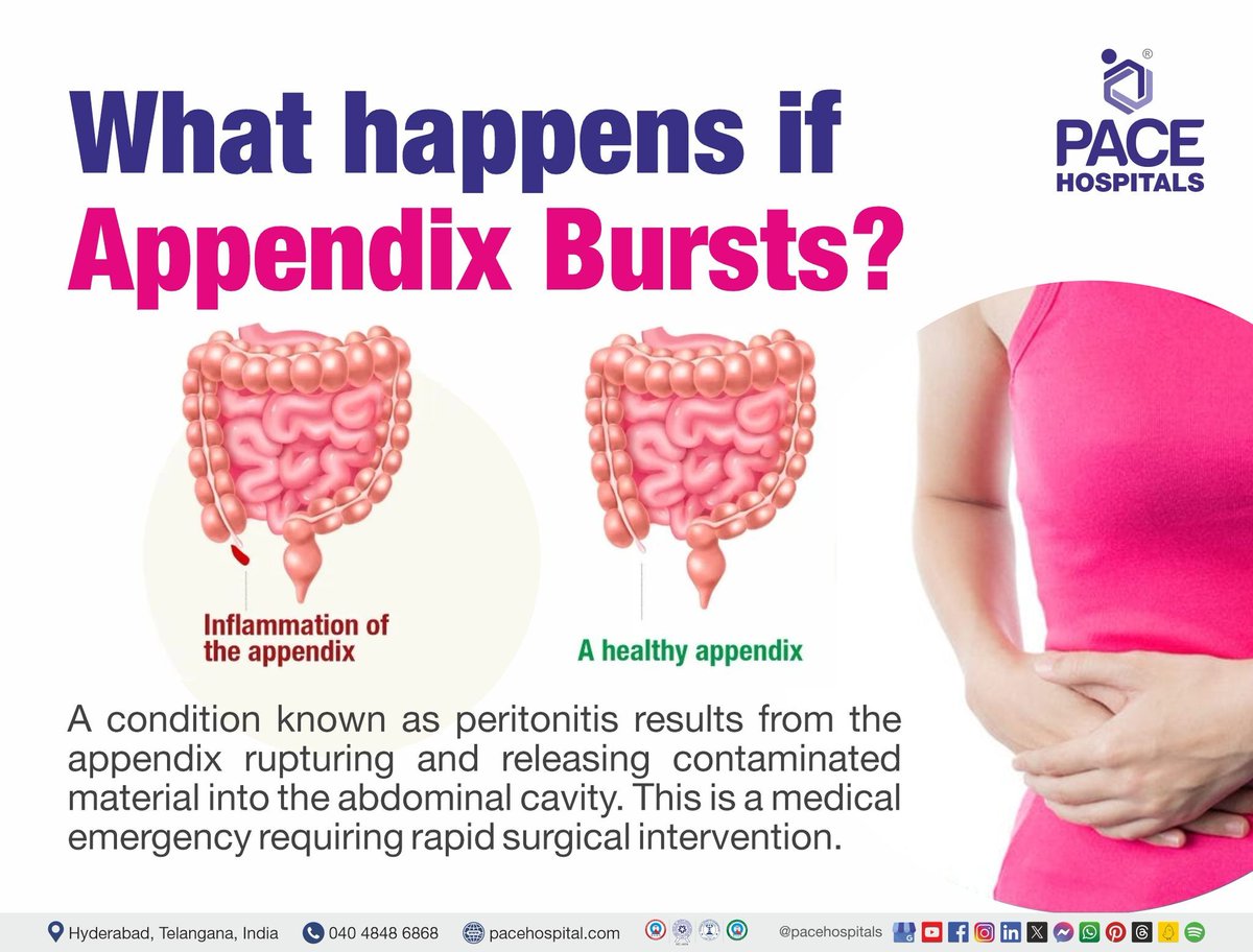 PACEHospitals's tweet photo. #Appendicitis is the #inflammation of the #appendix, a small pouch-like structure attached to the beginning of the large intestine. 

Know more: https://t.co/iPCwMG44qj

#acuteappendicitis #chronicappendicitis #abdominalpain #painmanagement #pacehospitals #hyderabad #india https://t.co/gy9Xxf6r8J