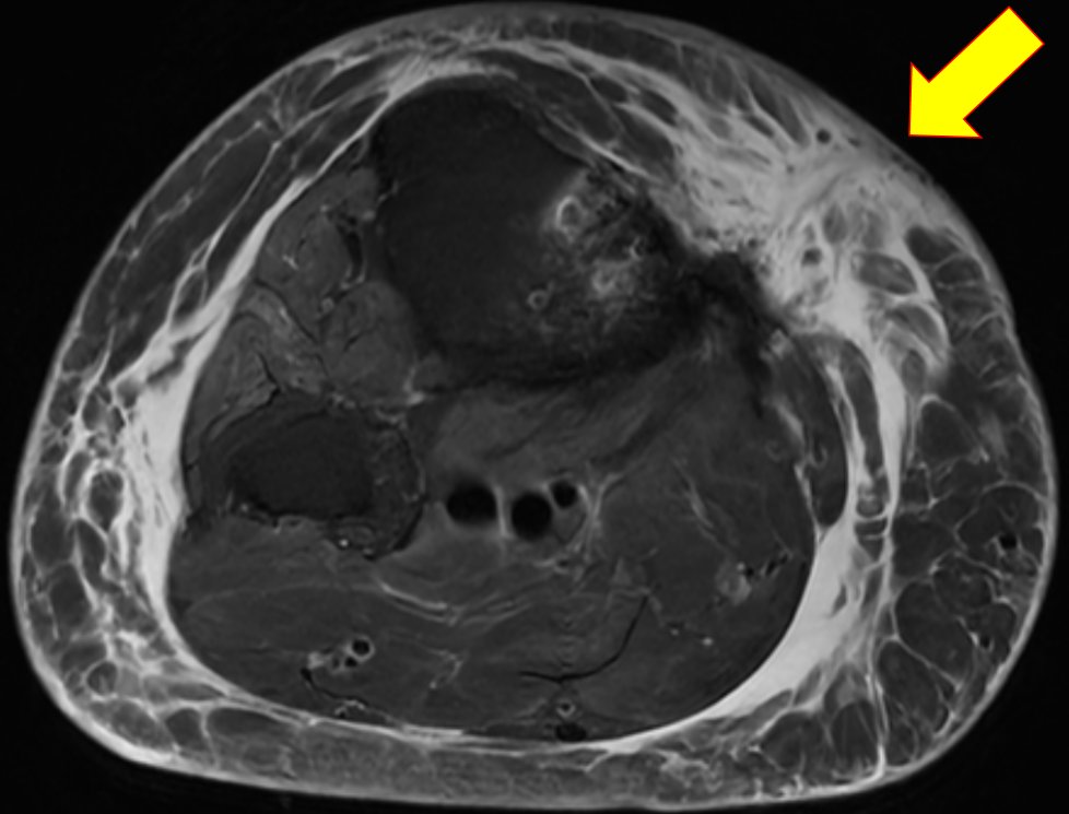 EricMadPatho's tweet image. 70/F with a h/o kidney transplant in 2006, on immune suppressants. Patient felt a 1cm tumor below the skin on her right knee last May, but walking became painful despite oral ABx. MRI revealed necrotizing fasciitis. GMS+, Mucicarmine+ cryptococcosis. #PathBugs #crittersontwitter