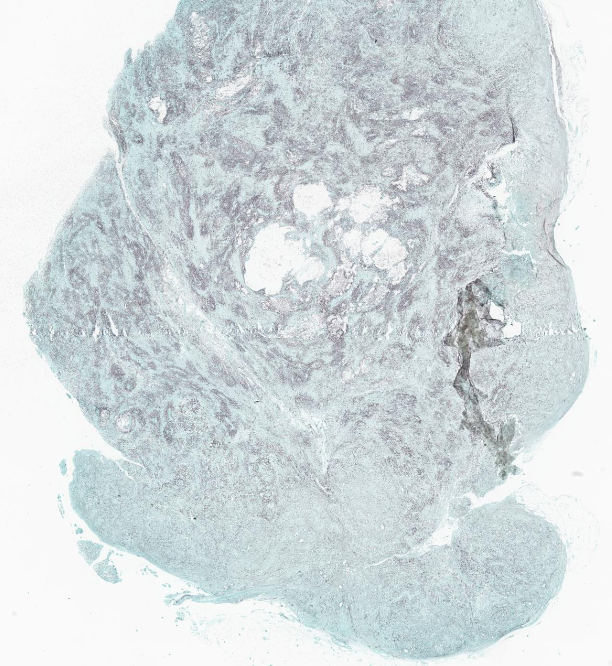 EricMadPatho's tweet image. 70/F with a h/o kidney transplant in 2006, on immune suppressants. Patient felt a 1cm tumor below the skin on her right knee last May, but walking became painful despite oral ABx. MRI revealed necrotizing fasciitis. GMS+, Mucicarmine+ cryptococcosis. #PathBugs #crittersontwitter