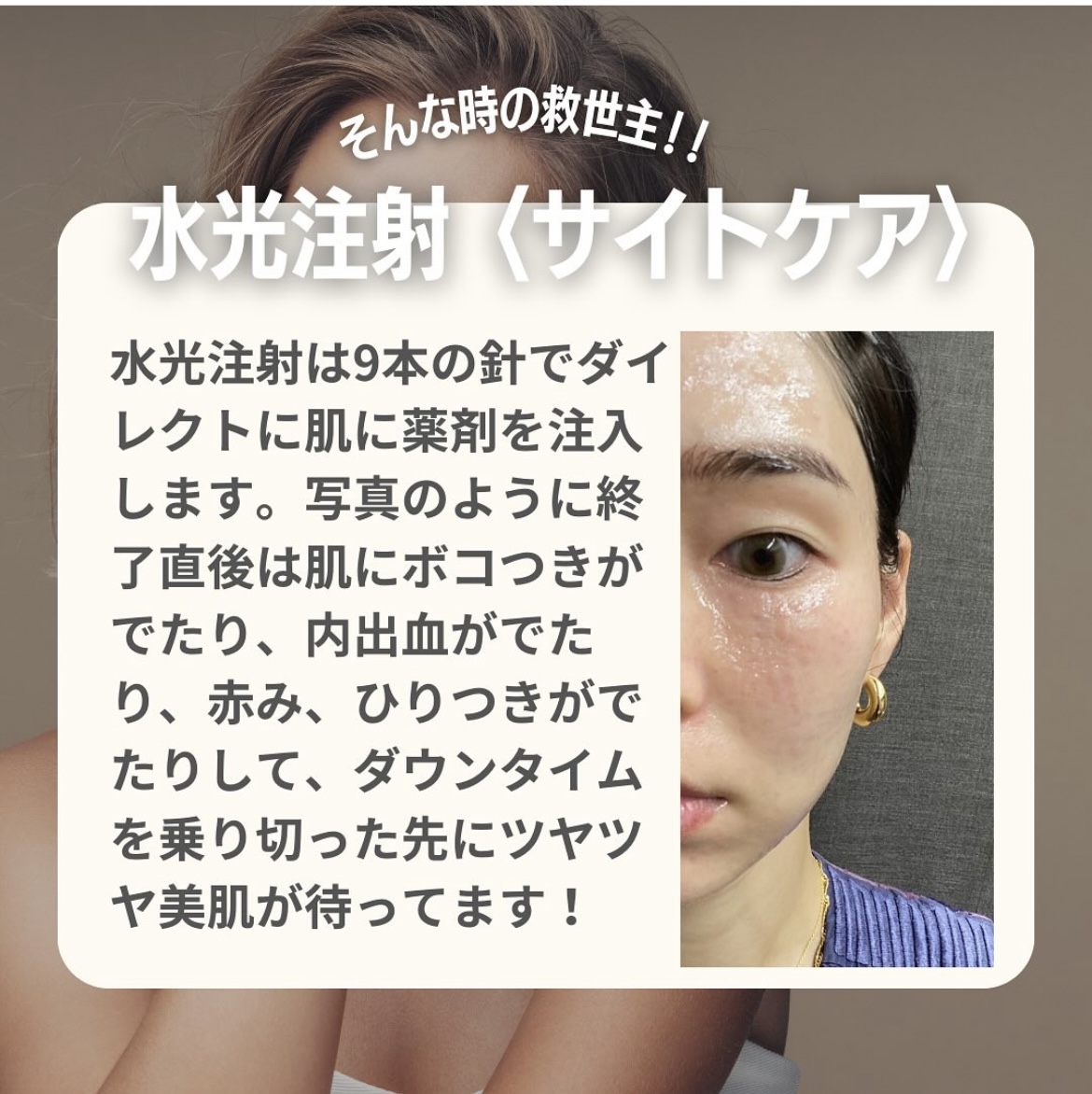 ClairClinic's tweet photo. 美容ナースの休日肌メンテをご紹介します👏🏻👏🏻
今回は水光注射です💉

ダウンタイムを乗り切った先にツヤツヤ美肌が
待ってますので、ダウンタイムは考慮して
ご予約してくださいね✨

CYTOCARE：¥55,000→LINE限定価格¥44,000
 PINK GROW：¥49,500→LINE限定価格¥39,600
 プラチナムマスク・麻酔付き❣️ https://t.co/hM7kyIQ04n