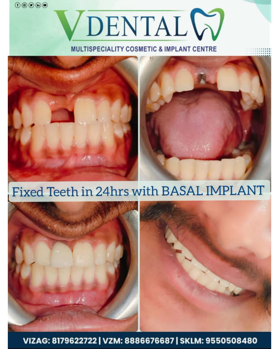 vdentalhospital's tweet photo. **V Dental Hospital: Basal Implants Transform Smiles!**
π **Before:** Missing or damaged teeth causing discomfort?
π **After:** Get Fixed Teeth in 24 hours with Basal Implants! Regain your smile's confidence and function effortlessly.
#basalimplants #24hourfix #vdentalcare https://t.co/tI2KCs2ydk