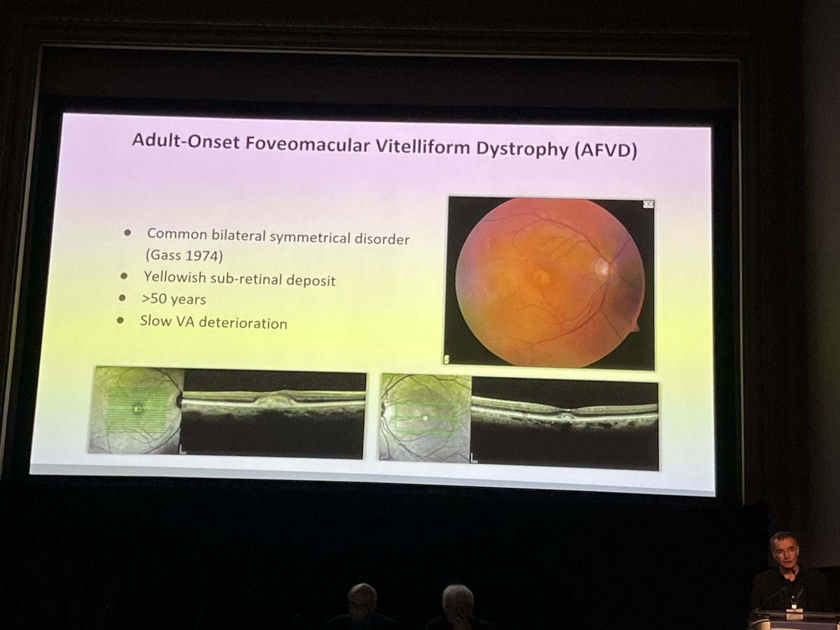 Great talk on adult-onset foveomacular vitelliform dystrophy (AFVD). Itay Chowers, MD, suggested a possible overlap between AMD and AFVD via the complement cascade. #ACRC2024 #Retina #Macula2024