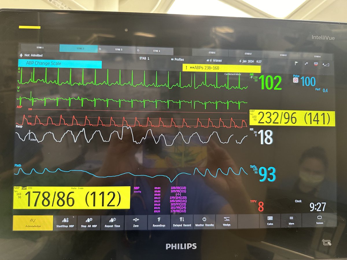 Never trust blood pressure cuff measurements in critically ill patients. Arterial line pressure on upper right, cuff pressure on lower left. jacc.org/doi/full/10.10…