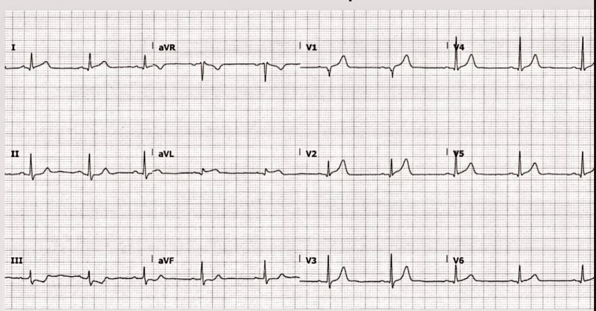 asmar097's tweet photo. 74-year-old man presenting with one hour of central chest pain

Diagnosis?
Treatment? https://t.co/fu0BI9J08J
