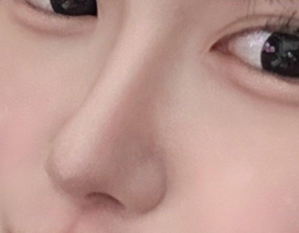 dpsnll's tweet photo. 小鼻縮小の内側法はやばい
鼻の穴小さくなって小鼻大きく見えるし、最悪な手術ってツイート見たんだけど人それぞれよね！私めっちゃ満足してる。小鼻縮小して鼻完成したなって感じ https://t.co/Mr0SvILRTI