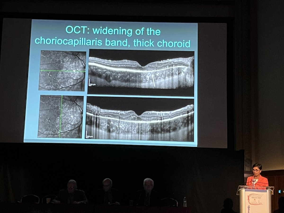 Looking for evidence of amyloid in the eye? Check the choriocapillaris band on OCT, according to Anita Agarwal, MD. #ACRC2024 #Retina #Macula2024