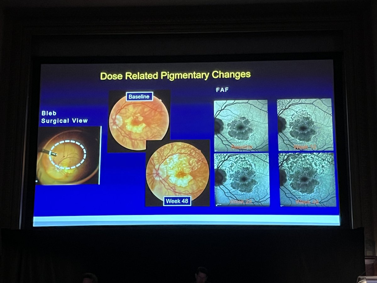 Nadia K. Waheed, MD, MPH, shared her imaging findings in patients treated with gene therapy, including signs of inflammation, atrophy, and retinotomy-related, outer retina, and pigmentary changes. #ACRC2024 #Retina #Macula2024