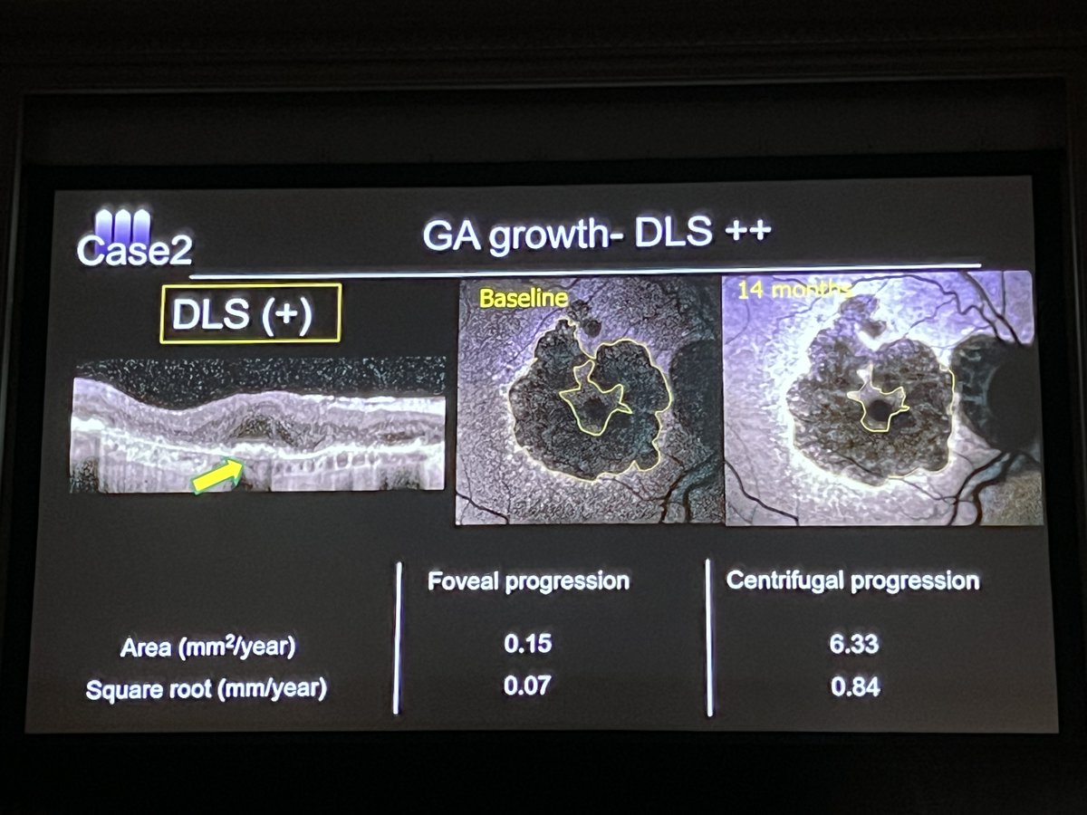 Amani A. Fawzi, MD, and her team looked at double-layer signs in fovea-sparing GA and found the presence of a thick double-layer sign in the foveal area may play a protective role. #ACRC2024 #Retina #Macula2024