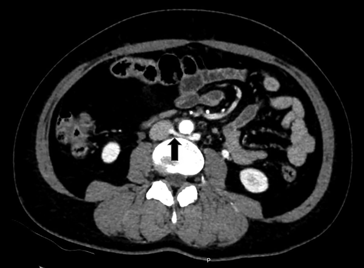 Applied_Rad's tweet photo. Posterior Nutcracker Syndrome with Left Renal Vein Duplication
Learn all about it β‘οΈ https://t.co/rNFxGDOXvg
#casestudy #RadEd #GIimaging https://t.co/Bly0vpuyCM