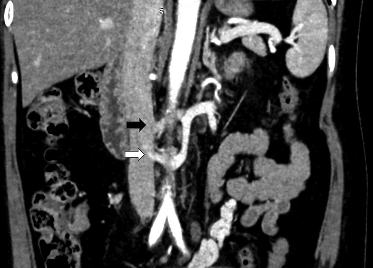 Applied_Rad's tweet photo. Posterior Nutcracker Syndrome with Left Renal Vein Duplication
Learn all about it β‘οΈ https://t.co/rNFxGDOXvg
#casestudy #RadEd #GIimaging https://t.co/Bly0vpuyCM