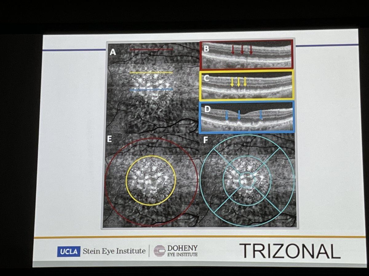 David Sarraf, MD, discussed his team’s recent findings related to dot, ribbon, and soft drusen, suggesting a trizonal pattern in 31 of 33 eyes (94%). #ACRC2024 #Retina #Macula2024
