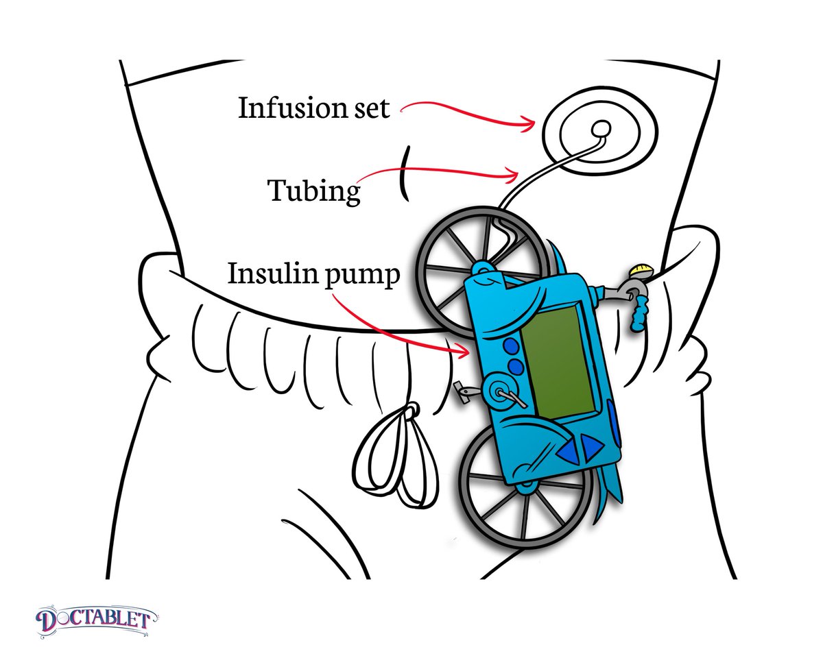 Doctablet's tweet photo. An insulin pump is becoming a more common way to manage Both #diabetes Type 1 and Type 2. You can understand it better if you think of a bicycle https://t.co/OApGLuJ67I https://t.co/zxAmSlhCtg