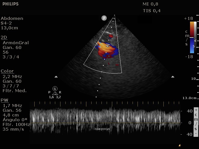 Diagnosis of fat embolism syndrome using point‐of‐care ultrasound Sonography DOI: doi.org/10.1002/sono.1… Share link: onlinelibrary.wiley.com/share/author/G… #POCUS #fatembolism #Doppler