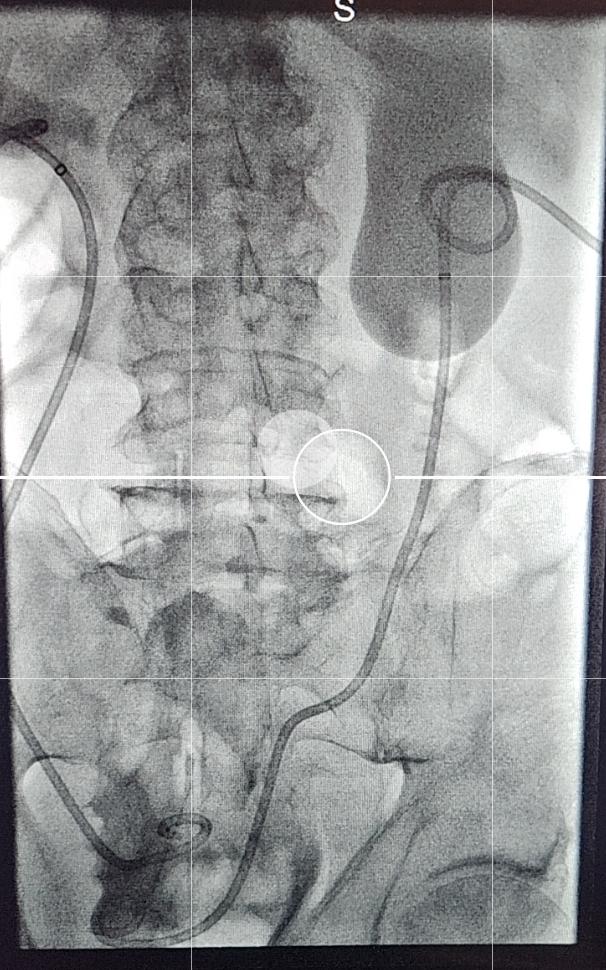 MohmdHalaibeh's tweet photo. Sometimes you have to make a turn or two to get to the bladder!π
I'm in favor of primary NUS because a once a PCN is placed most of the time the patient is stuck with it.
#TWITTIR #twittermd #irad #MedTwitter https://t.co/NBYhE1ckFd