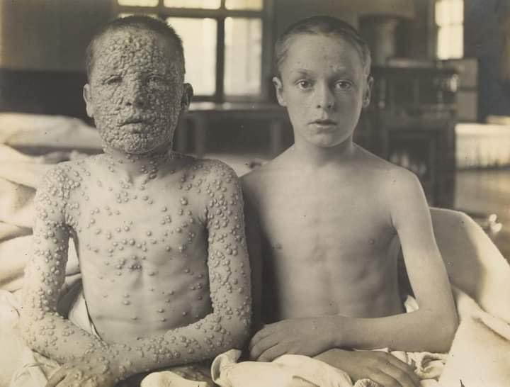 InformaCosmos's tweet photo. EL PODER DE LAS VACUNAS

Esta foto fue tomada en 1901 por el Dr Allan Warner en el Hospital de Laicester, Reino Unido. A la izquierda tenemos a un niño que no fue vacunado y que contrajo la viruela, y a la derecha otro niño que si recibió la vacuna contra la misma dolencia.

Una de las enfermedades mortales más antiguas y difíciles de erradicar fue la viruela, que se originó en la Antigüedad Clásica y duró hasta 1977, año en que se registró en Somalia, el último caso de contagio natural.