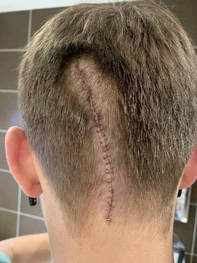 TheCavernoma's tweet image. In the interval for @TLBTmusical and NOTHING has ever felt so real! Mum &amp;amp; Dad have cried all the way through and I am just, well I’m not alone anymore. This just enforces, it’s about #AbilityNotDisability, there is an ever after and a reason to live! #TheWorldIsWaitingForYou🎶💪🏻