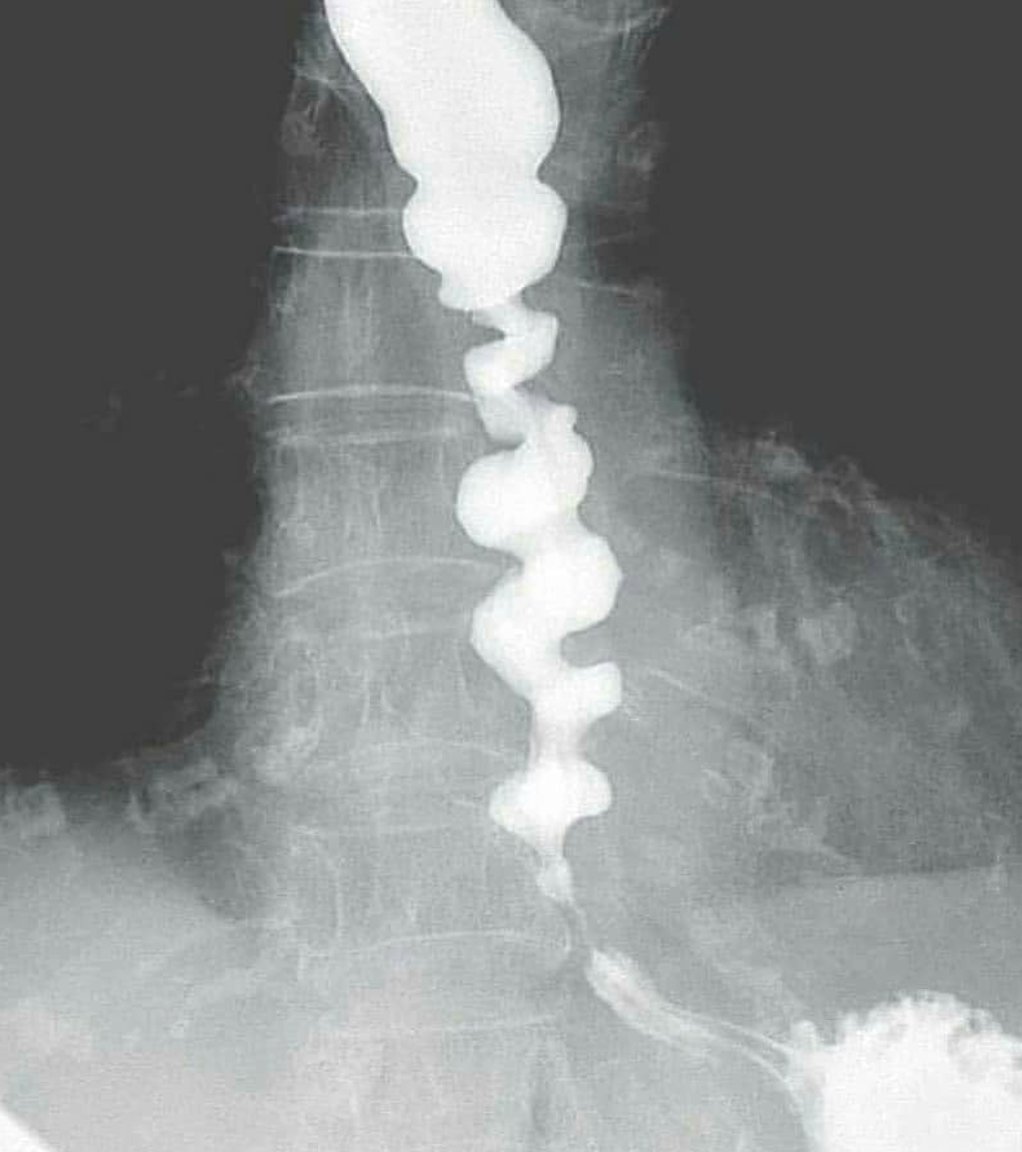Yes!! this is an esophagus!!!

Do you know the diagnosis and how to treat it? 👀
