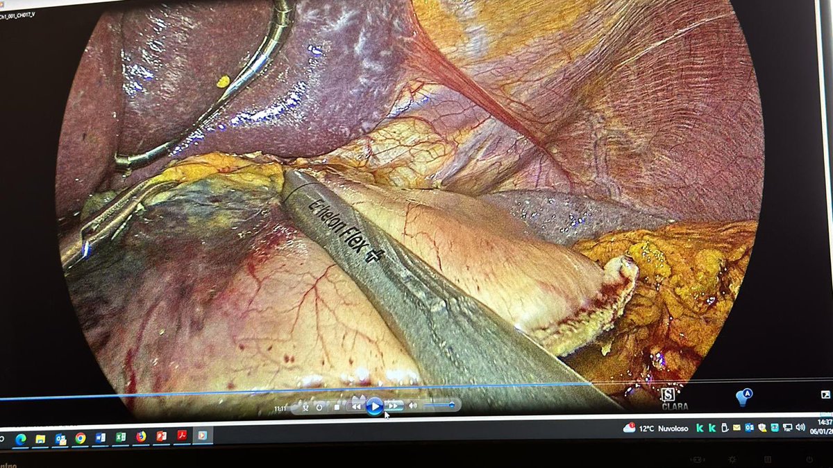 95 percent laparoscopic D2 gastrectomy for cancer with ICA roux en y. The value of endoscopic spot ex marking of surgical margins