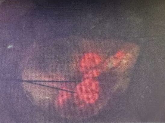 ARODMDPHD's tweet image. I do love working under blue light with 5-ala but the overlay feature in white light can be helpful. I find getting hemostasis is easier with white light but helpful to know regions of highest fluorescence. #glioma #gleolan #5ala #exoscope #aeos