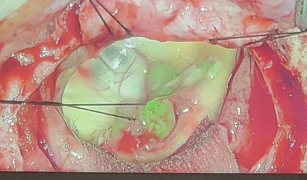ARODMDPHD's tweet image. I do love working under blue light with 5-ala but the overlay feature in white light can be helpful. I find getting hemostasis is easier with white light but helpful to know regions of highest fluorescence. #glioma #gleolan #5ala #exoscope #aeos