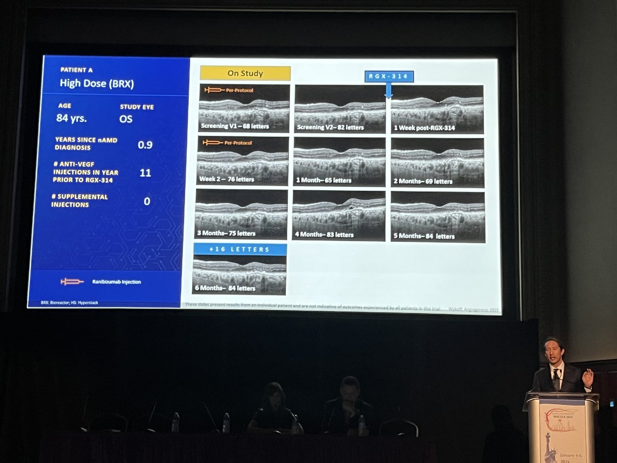 Gene therapy is happening now, and it’s time to pay attention in retina, according to Allen C. Ho, MD. Last month (Dec. 8, to be exact), a CRISPR exa-cel therapy was approved for sickle cell disease. Gene therapy for wet AMD is in phase 3 too. #ACRC2024 #Retina #Macula2024
