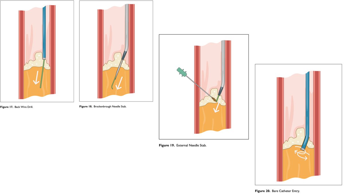 Tough #PeripheralCTO?
But No #CTOcrossingDevice?

No problem

Try 1 of these 20 peripheral #CTOcrossingTechniques with basic tools

&amp;  Join us at #FYA2024 in London, UK on Jan 26-28 2024 where IR/VS/IC collaboration is thriving

fya-congress.com

researchgate.net/publication/37…
