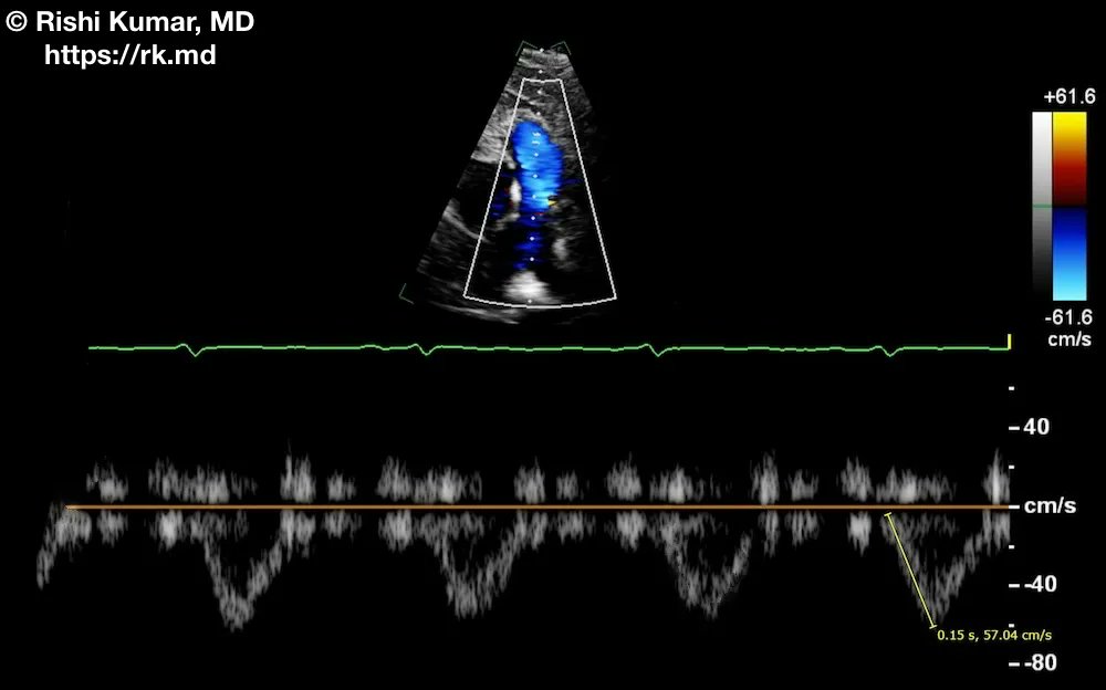 Pulm. velocity accel time (PVAT) estimates the severity of PA pressure elevation when TR jets are difficult to analyze. PVAT = time from flow onset to peak velocity. PWD at the PV in this PSAX #TTE shows a PVAT ~ 150 ms (normal is > 130 ms). #echofirst #medtwitter