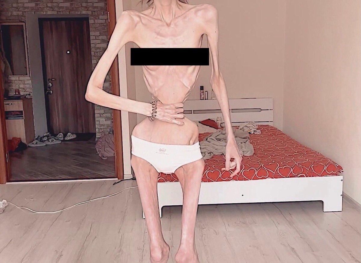 DichotomyKcals's tweet photo. 🧵 extreme deathspo thread, pt. 3 🧵

Major TW !!!

♡ / ↻ appreciated

🏷️ tags for reach 🏷️ deathspo bonespo hospitalspo sickspo thinspo th1nspo th1nsp0 edtwt 3dtwt eedeetwt anatwt miatwt edtwtthread https://t.co/b23jBvPydE