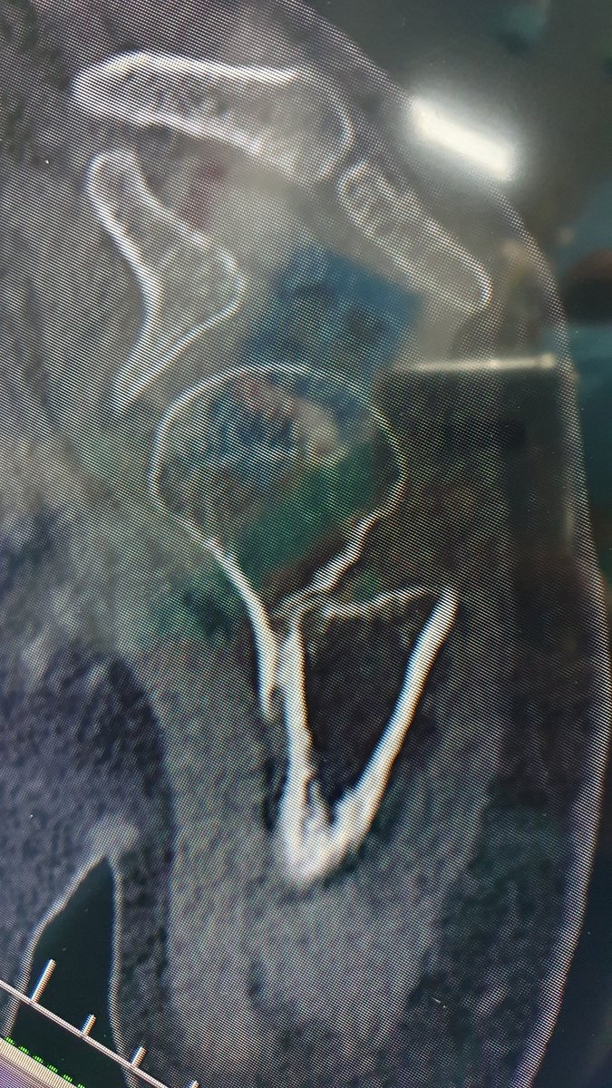 surgeonfk's tweet photo. 6/12 malunion, nonunion trested with Osteotomy, bone grafting &amp; good old "Philos" 2 the rescue ❤️‍🩹 https://t.co/oI7vquEDhM