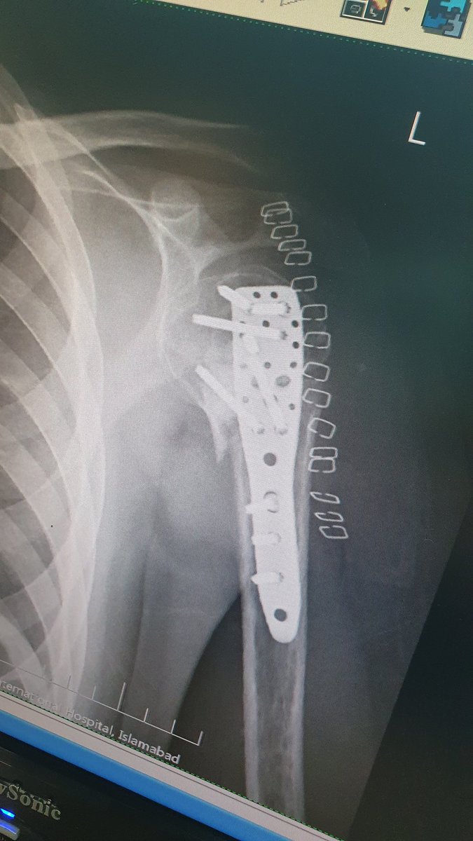 surgeonfk's tweet photo. 6/12 malunion, nonunion trested with Osteotomy, bone grafting &amp; good old "Philos" 2 the rescue ❤️‍🩹 https://t.co/oI7vquEDhM