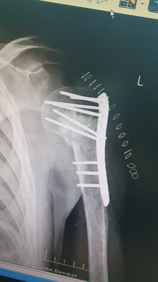 surgeonfk's tweet photo. 6/12 malunion, nonunion trested with Osteotomy, bone grafting &amp; good old "Philos" 2 the rescue ❤️‍🩹 https://t.co/oI7vquEDhM