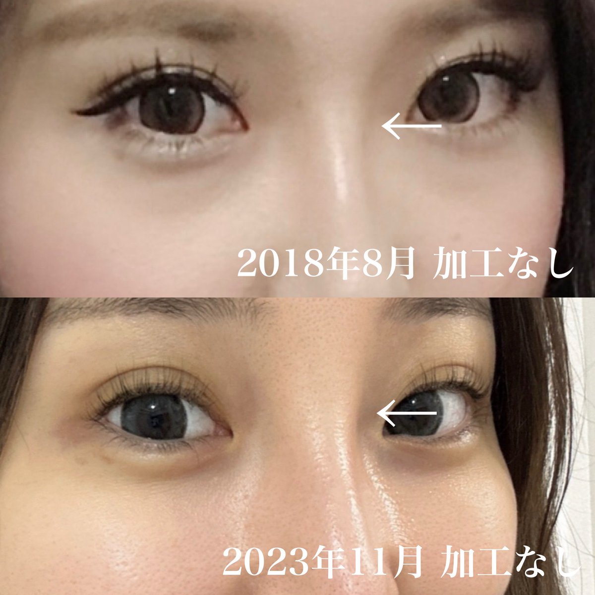 purinchandayo3's tweet photo. ⚠️鼻ヒアル入れる上で知っておいた方がいいこと
ヒアルロン酸は時間が経つにつれ
高さが減り、横に伸びます👃

鼻根をみてもらえればお分かりの通り
5年でかなり鼻根が太くなりました

ヒアルで作る美は永遠ではないので
ヒアルは鼻フルする前のイメトレとして注入することをお勧めします🌸 https://t.co/OJW4GOSTMC