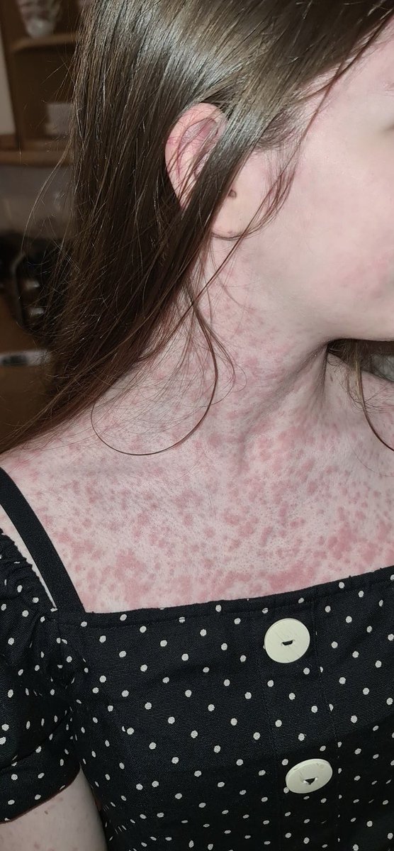 drkeithsiau's tweet image. 15F with this rash across the back, chest, arms and legs erupting over 24 hours and persisting after 1 week. No obvious precipitants. Any thoughts? #TwitterConsult #WithConsent