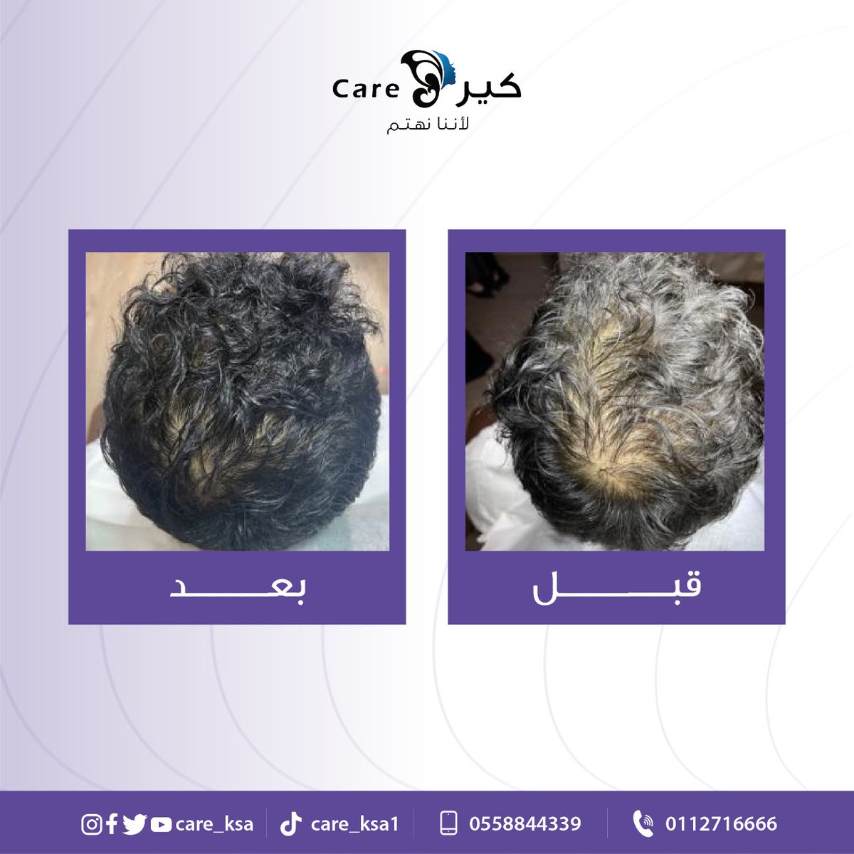 نتيجة علاج الشعر بإجراء الريجينيرا مع الدكتور سليمان الفرج 
 <a href="/Dr_SAlFaraj/">د. سليمان الفرج</a>