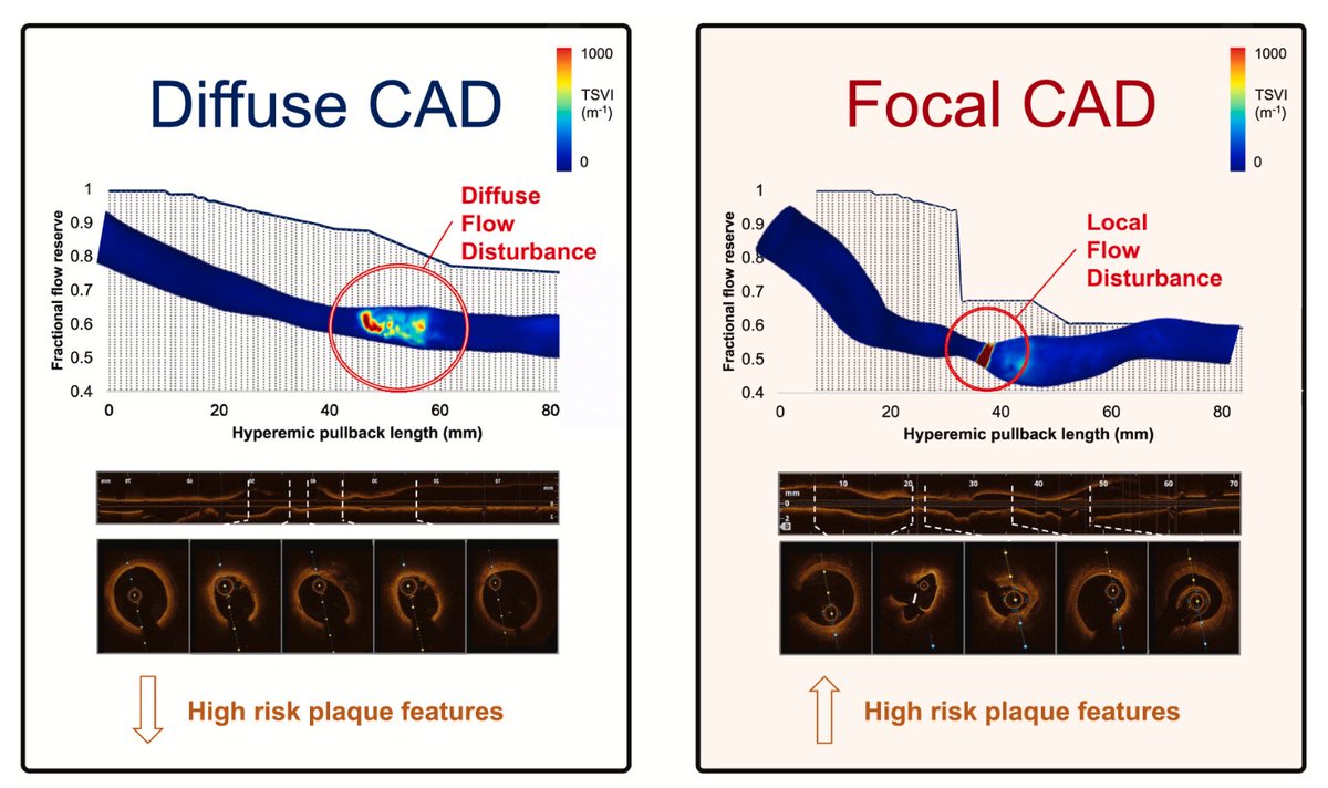 In our recent analysis, focal coronary lesions (identified by #PPG) presented not only adverse plaque composition, but also dangerous flow disturbance #WSS ! Focal lesions are the enemy! thanks @CoreAalst @PoliTOnews @ColletCarlos internationaljournalofcardiology.com/article/S0167-…