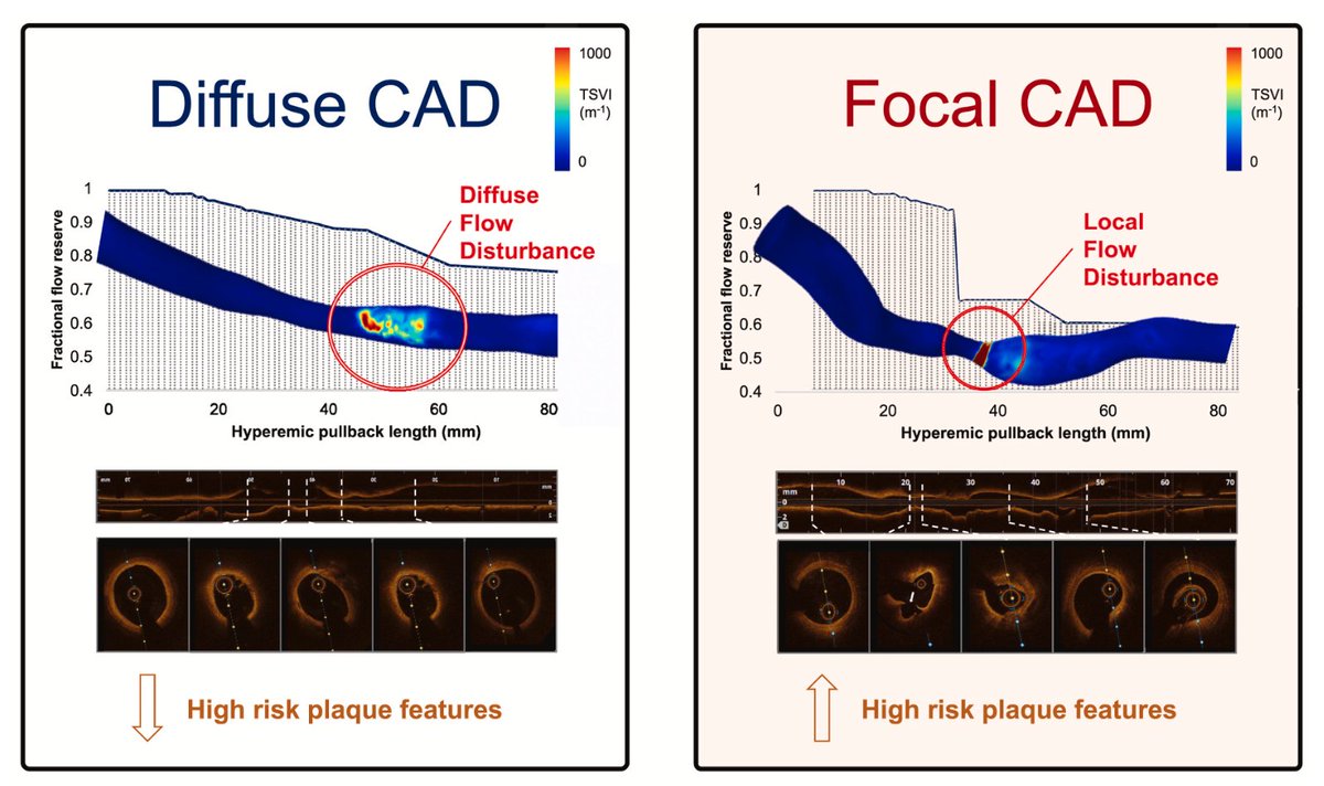 alecandreva's tweet photo. In our recent analysis, focal coronary lesions (identified by #PPG) presented not only adverse plaque composition, but also dangerous flow disturbance #WSS ! Focal lesions are the enemy!

thanks @CoreAalst @PoliTOnews @ColletCarlos 

https://t.co/bs0axs2weu https://t.co/RIiDCwLhOC
