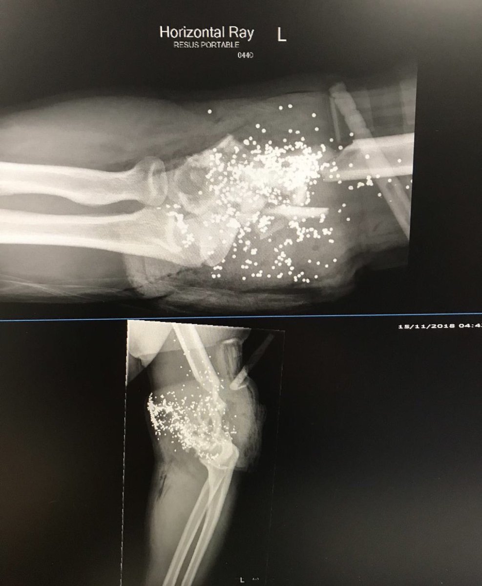 X-ray image shows the horrifying aftermath of getting shot in the elbow with a 12 gauge shotgun.