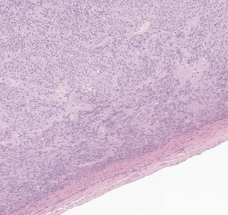 EricMadPatho's tweet photo. Stomach submucosal tumors can be differentiated at low power. Lymphoid cuffing suggests schwannoma, while its absence supports GIST (even if parts look like verocay!) #GIpath #pathX #pathology https://t.co/GRf2RQaRSx