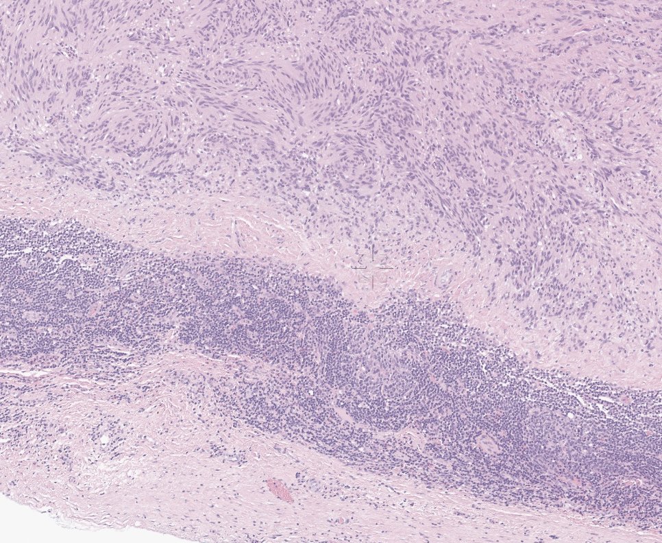 EricMadPatho's tweet photo. Stomach submucosal tumors can be differentiated at low power. Lymphoid cuffing suggests schwannoma, while its absence supports GIST (even if parts look like verocay!) #GIpath #pathX #pathology https://t.co/GRf2RQaRSx