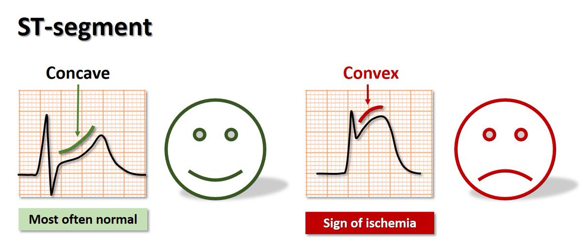 emergencyclub1's tweet photo. 🩺 Classic EKG in Pericarditis:
  - Diffuse ST elevations
  - Concave upwards STE
  - PR depressions in multiple leads (viral)
  - PR elevation in aVR

🔴 Ruling out STEMI:
  - STE III > STE II (strongly favors STEMI)
  - STD in leads other than aVR/V1 (indicates acute MI)
  - Presence of new Q waves
  - STE convex upwards or horizontal (favors STEMI)

#Cardiology #EKG #STEMI