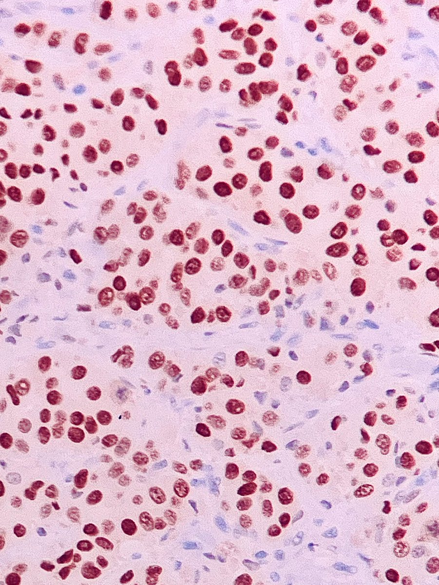 Immanuel_Paul30's tweet photo. Note the cells with abundant densely eosinophilic granular cytoplasm with prominent macronucleoli with perinucleolar clearing. Cell dyscohesion (cyto smears) is a soft clue.
AR shows strong and diffuse nuclear staining.
60s/M - parotid gland
#PathTwitter #HNpath #impath https://t.co/nXuC1Jx86v