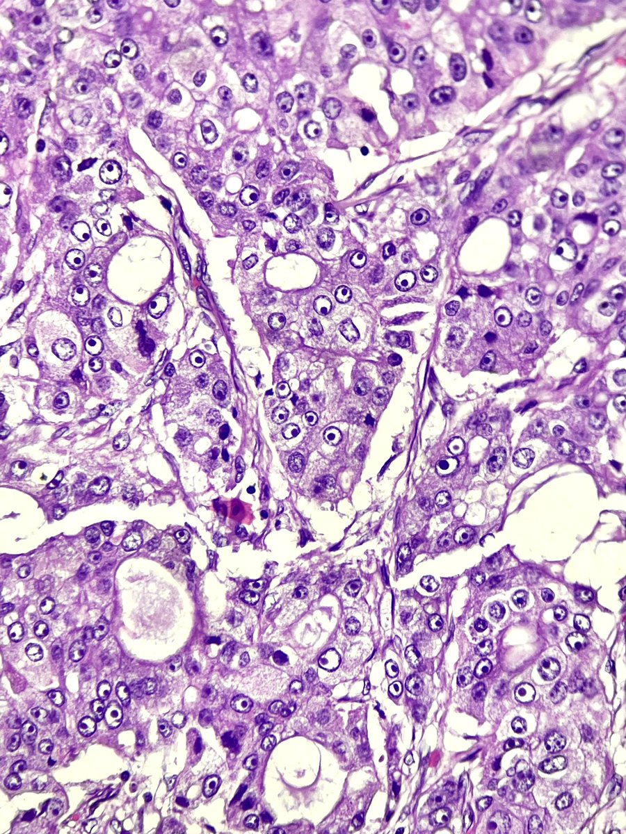 Immanuel_Paul30's tweet photo. Note the cells with abundant densely eosinophilic granular cytoplasm with prominent macronucleoli with perinucleolar clearing. Cell dyscohesion (cyto smears) is a soft clue.
AR shows strong and diffuse nuclear staining.
60s/M - parotid gland
#PathTwitter #HNpath #impath https://t.co/nXuC1Jx86v