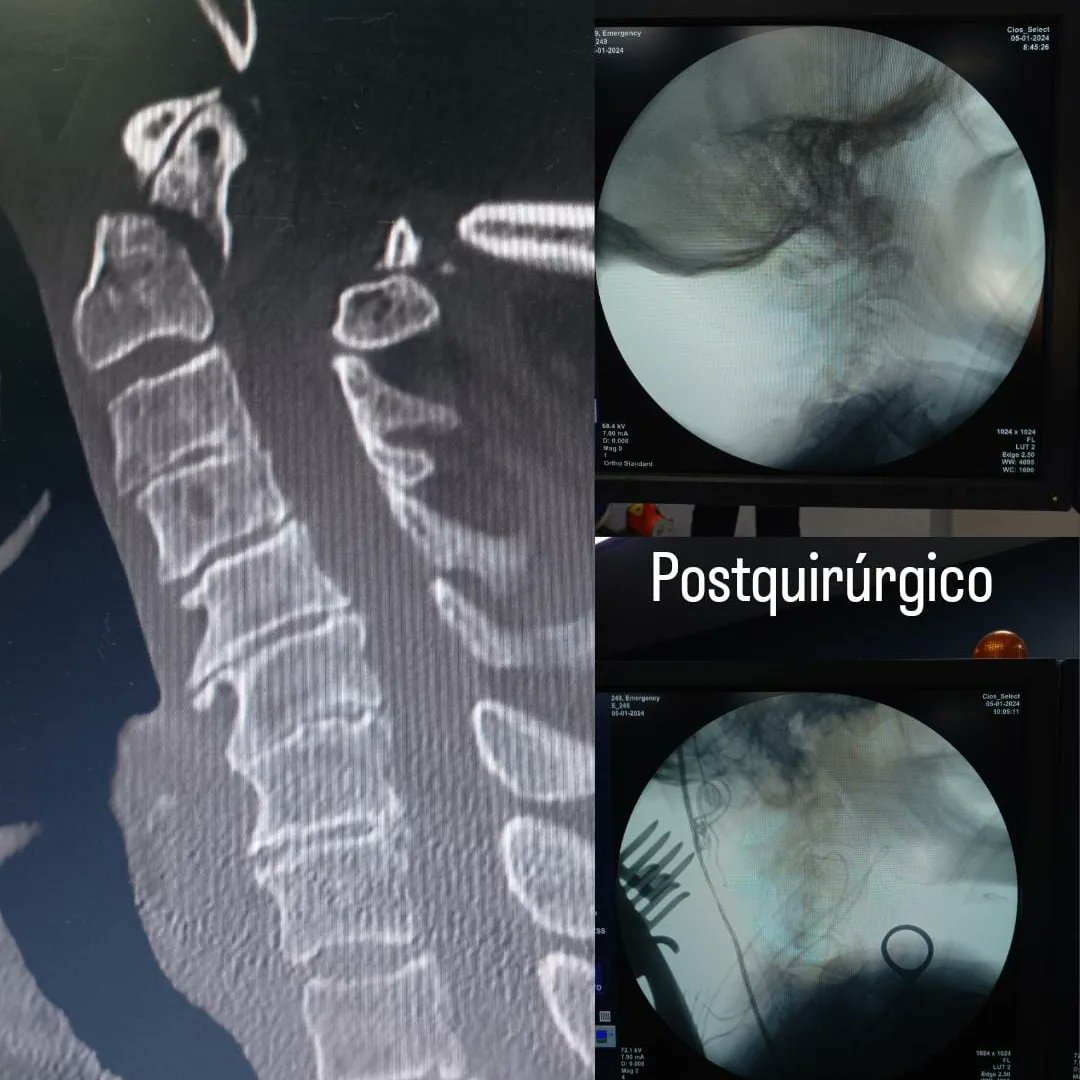 ✅Todo un hito: corrigen fractura cervical a adulto mayor de 93 años en Ingavi. ➕ Info al link goo.su/Ushby5A