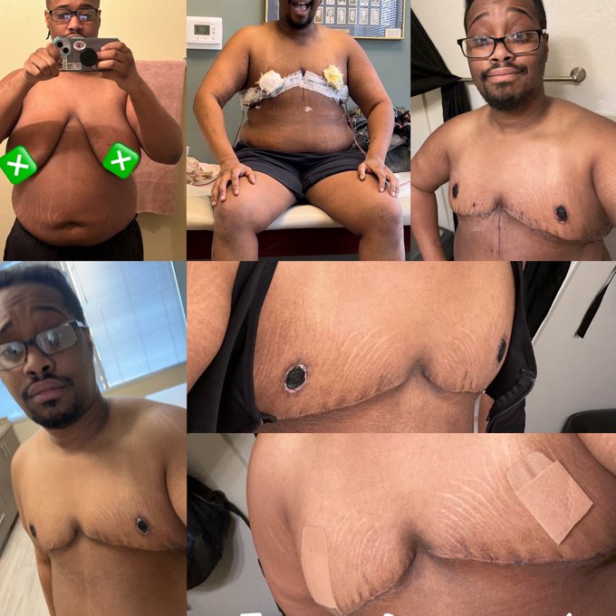 Still can&rsquo;t believe I&rsquo;m finally free. https://t.co/YI3sjh8s9y<a href="/tag/ftm"class="tags"><span>#ftm</span></a><a href="/tag/transawarenessweek"class="tags"><span>#transawarenessweek</span></a><a href="/tag/transman"class="tags"><span>#transman</span></a><a href="/tag/topsurgery"class="tags"><span>#topsurgery</span></a>