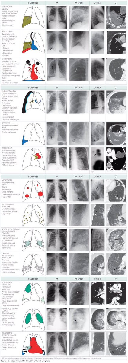 BrownJHM's tweet image. Common lung abnormalities 🫁 #radiology